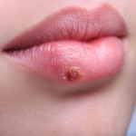 Heal A Cold Sore (Fever Blister) Faster