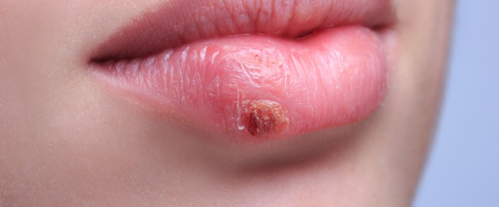 Heal A Cold Sore (Fever Blister) Naturally And Faster